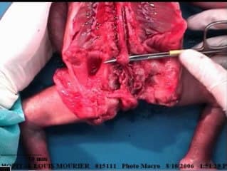 Extrophie, omphalocele