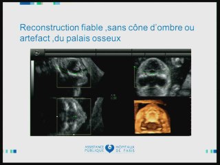 Insuffisances, incertitudes, difficultés, piéges et erreurs de l'imagerie anténatale L'os.