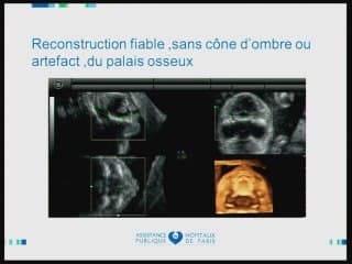 Insuffisances, incertitudes, difficultés, piéges et erreurs de l'imagerie anténatale L'os.