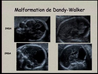 Dysgénésie vermienne et autres hypoplasies cérébelleuses