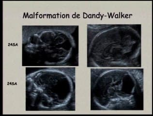 Dysgénésie vermienne et autres hypoplasies cérébelleuses