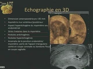 L’endométriose Flash adénomyose et échographie 3D