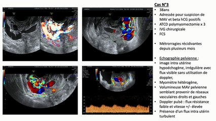 Malformations arterio-veineuses utérines