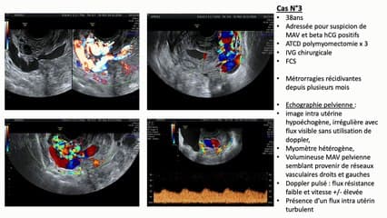 Malformations arterio-veineuses utérines
