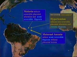 Hémodynamique foetale en liaison avec l’hypoxie (anémie, paludisme, etc.)