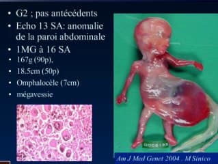 Echographie du 1er trimestre, jusqu'ou peut on aller : Enquête de la SOFFOET sur les IMG du 1er trimestre 2/2
