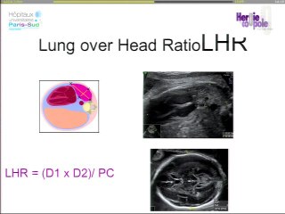 Hernies de coupoles diaphragmatiques : Comment optimiser le dépistage échographique (diagnostic différentiel, formes isolées) ?