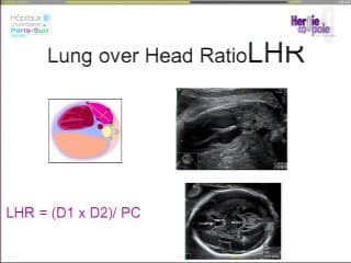 Hernies de coupoles diaphragmatiques : Comment optimiser le dépistage échographique (diagnostic différentiel, formes isolées) ?