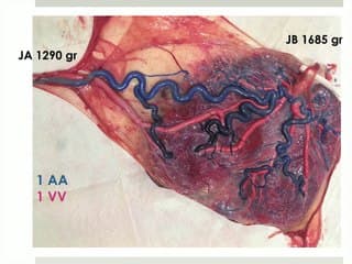 DO type 3 sur des grossesses monochoriales.