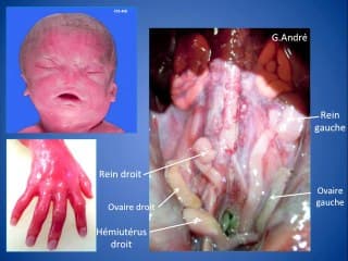Super caryotype pour peine de coeur