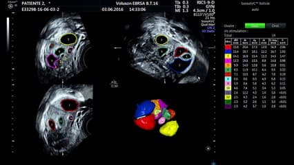 Live autour de la PMA