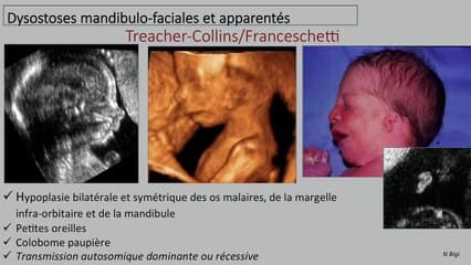 QUE SUSPECTER DEVANT UN RETROGNATISME EN PRÉNATAL ?