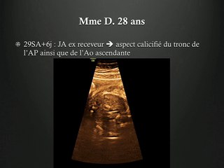 Calcifications artérielles multiple après traitement au laser par foetoscopie d'un STT