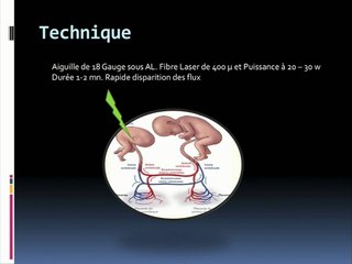9 Place du Laser interstitiel dans les grossesses monochoriales