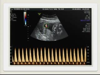 La discordance gémellaire.