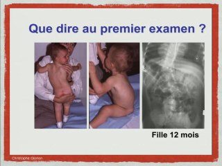 ANOMALIES DES VERTEBRES Traitement et devenir à long terme