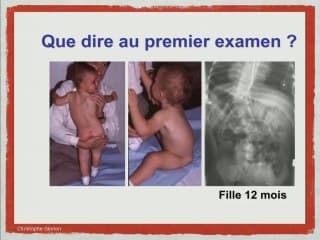 ANOMALIES DES VERTEBRES Traitement et devenir à long terme