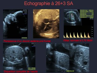 Fœtopathie infectieuse discordante à Parvovirus B19 : hypothèses physiopathologiques, à propos d’un cas et revue de la littérature
