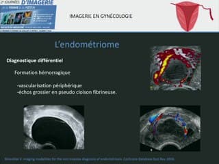 Endome_triose / adénomyose ? Quels signes échographiques ? ? Quelles astuces pour une échographie sensible ?