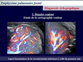 De l'obstacle bronchique transitoire à l'emphysème géant.