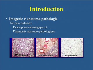 Malformations bronchopulmonaires : un dépistage efficace, pour quel pronostic ? Confrontations des données anté et post-natales.
