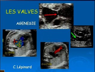 Vascularisation pulmonaire : mesures - doppler