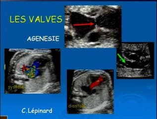 Vascularisation pulmonaire : mesures - doppler