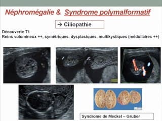 REINS, VOIES URINAIRES, ORGANES GÉNITAUX EXTERNES : Néphropathies et anomalies de la taille des reins