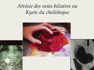 Comment gérer un kyste sous-hépatique ?