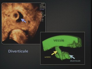 Echographie du périnée féminin