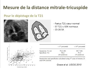 ILVAV ET T21