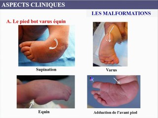 Du pied bot varus équin aux différentes malpositions du pied :  comment préciser le diagnostic en échographie.