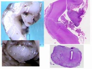 La fosse postérieure