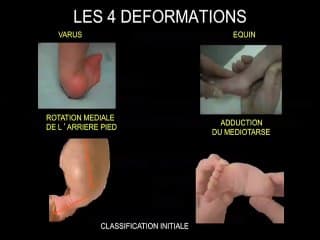 Prise en charge : méthode fonctionnelle et traitement chirurgical