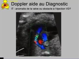 Intérêt du doppler dans l’exploration du coeur normal et pathologique