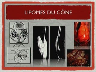 ANOMALIES DU TUBE NEURAL Quel pronostic ? Quel traitement ?