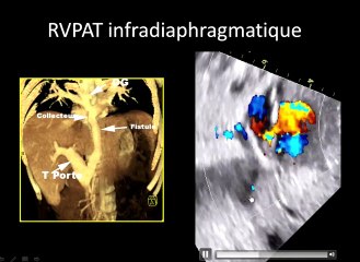 Exemples de retours veineux pulmonaires anormaux