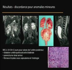 Autopsie virtuelle Corrélations imagerie-foetopathologie : expérience du GRIFF.