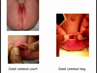 Les Centres de référence Maladies Rares : leurs missions Exemple du Centre de référence MAREP pour les malformations ano-rectales et pelviennes rares