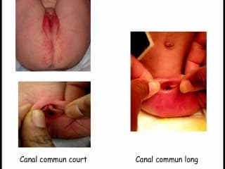Les Centres de référence Maladies Rares : leurs missions Exemple du Centre de référence MAREP pour les malformations ano-rectales et pelviennes rares