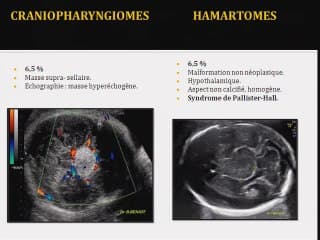 les tumeurs cérébrales foetales