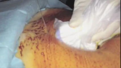 technique de l' amniocentese