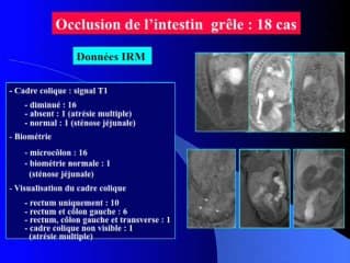 Les occlusions foetales