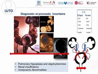 UROPATHIES / NEPHROPATHIES Quoi de neuf sur les uropathies ?