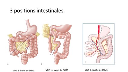 Intérêt du dépistage anténatal pour la prise en charge chirurgicale des malrotations du grêle