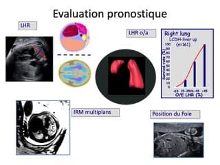 Hernie diaphragmatique droite. Mise au point et cohorte du CPDPN Béclère-Bicêtre