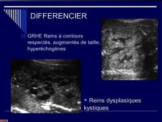 Reins échogènes