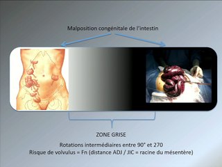 Le choc des images, le poids des mots : une interprétation de la réalité (volvulus, malrotation, laparoschisis, MAR….)