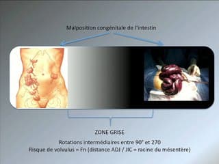 Le choc des images, le poids des mots : une interprétation de la réalité (volvulus, malrotation, laparoschisis, MAR….)