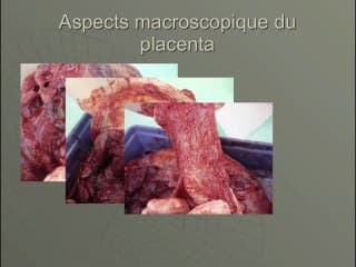 Dysplasie mésenchymateuse du placenta : diagnostic échographique